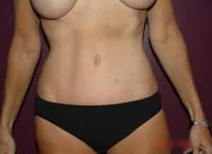 After Image: Tummy Tuck - front