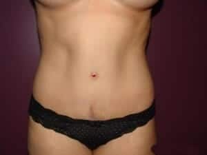 After Image: Tummy Tuck - front