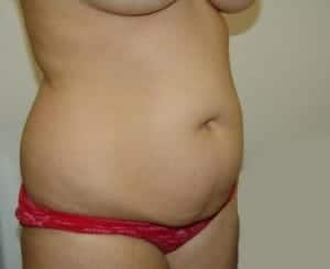 Before Image: Tummy Tuck - right-front-oblique