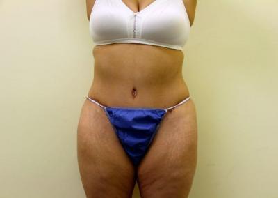 After Image: Tummy Tuck - front