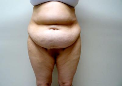 Before Image: Tummy Tuck - front