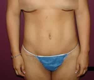 After Image: Tummy Tuck - front