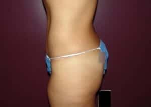 After Image: Tummy Tuck - left-side
