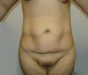 Before Image: Tummy Tuck - front