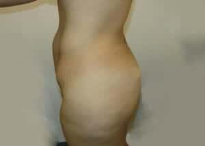 Before Image: Tummy Tuck - left-side