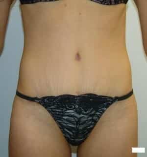 After Image: Tummy Tuck - front