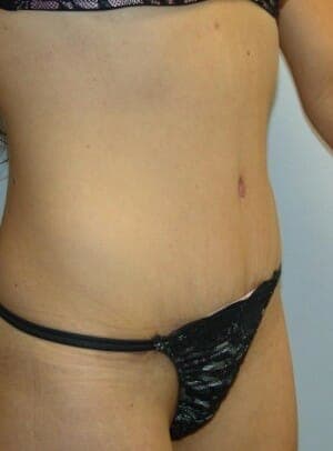 After Image: Tummy Tuck - right-front-oblique