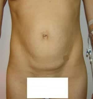 Before Image: Tummy Tuck - front