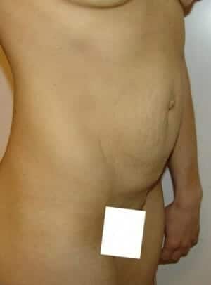 Before Image: Tummy Tuck - right-front-oblique