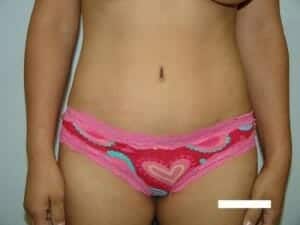 After Image: Tummy Tuck - front
