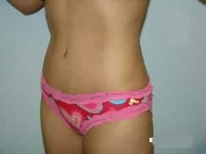 After Image: Tummy Tuck - left-front-oblique