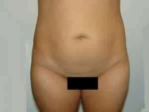 Before Image: Tummy Tuck - front