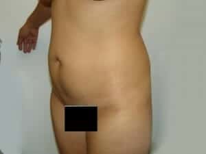 Before Image: Tummy Tuck - left-front-oblique