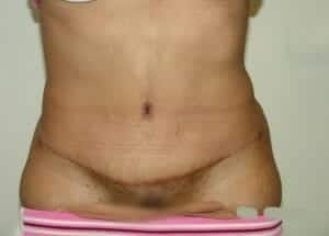 After Image: Tummy Tuck - front