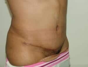 After Image: Tummy Tuck - right-front-oblique