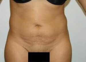 Before Image: Tummy Tuck - front