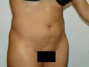 Before Image: Tummy Tuck - right-front-oblique