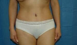 After Image: Tummy Tuck - front