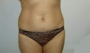 Before Image: Tummy Tuck - front