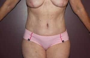 After Image: Tummy Tuck - front