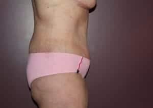 After Image: Tummy Tuck - right-side