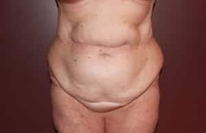 Before Image: Tummy Tuck - front