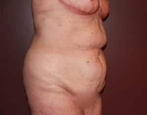 Before Image: Tummy Tuck - right-front-oblique