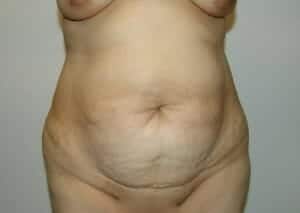 Before Image: Tummy Tuck - front