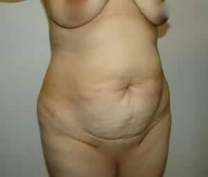 Before Image: Tummy Tuck - right-front-oblique