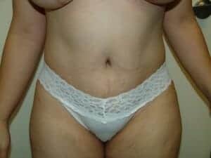 After Image: Tummy Tuck - front