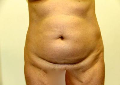 Before Image: Tummy Tuck - front