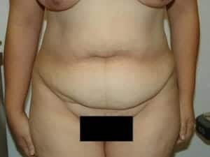 Before Image: Tummy Tuck - front