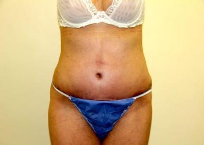 After Image: Tummy Tuck - front