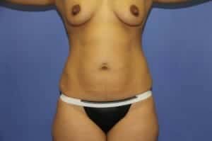 Before Image: Tummy Tuck - front