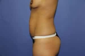 Before Image: Tummy Tuck - left-side