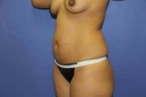 Before Image: Tummy Tuck - left-front-oblique