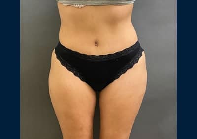 After Image: Tummy Tuck - front