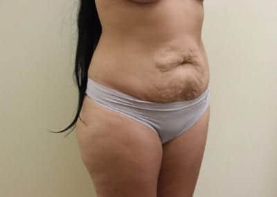 Before Image: Tummy Tuck - right-front-oblique