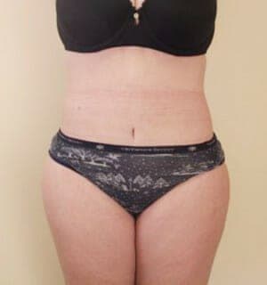 After Image: Tummy Tuck - front