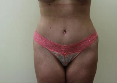 After Image: Tummy Tuck - front