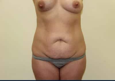 Before Image: Tummy Tuck - front