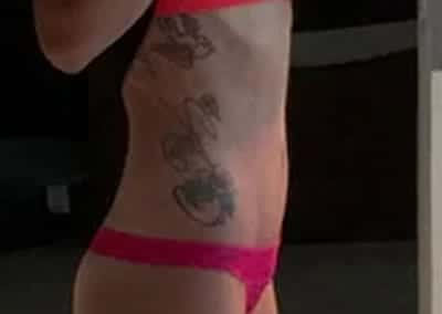 After Image: Tummy Tuck - right-side