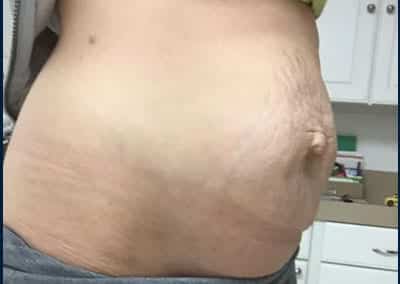 Before Image: Tummy Tuck - right-side