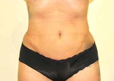 After Image: Tummy Tuck - front