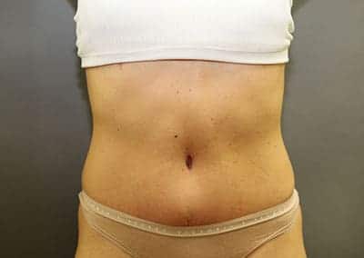 After Image: Tummy Tuck - front