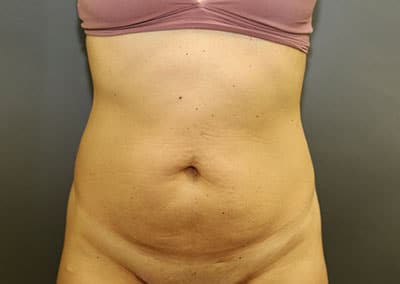 Before Image: Tummy Tuck - front