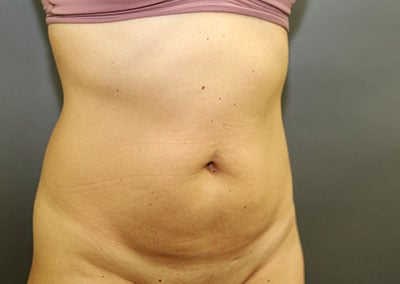 Before Image: Tummy Tuck - right-front-oblique