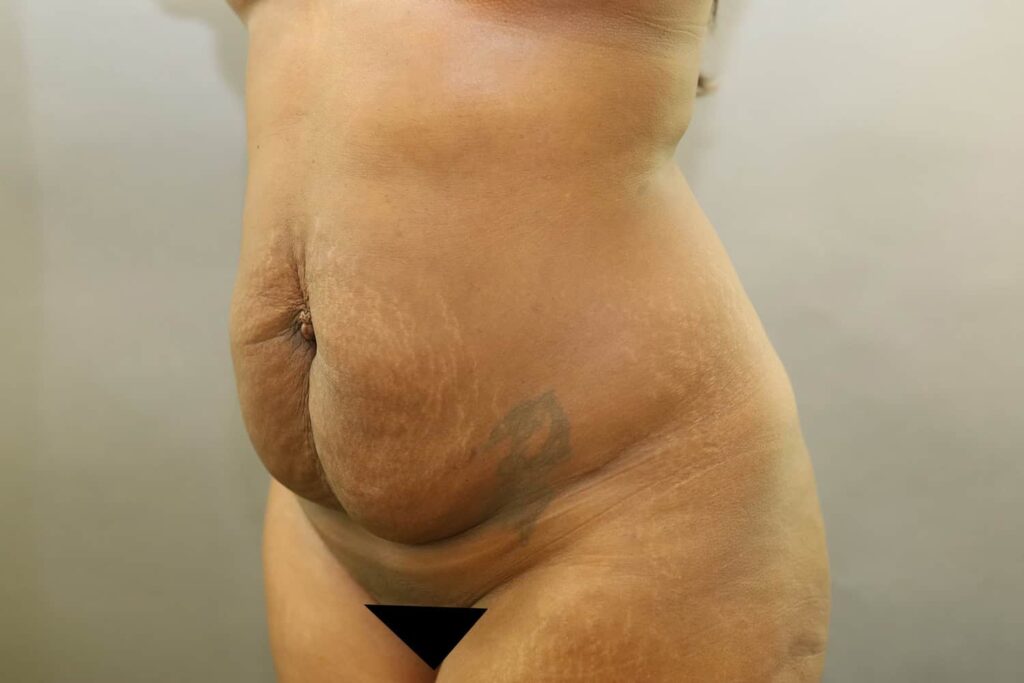 Before Image: Tummy Tuck - left-front-oblique