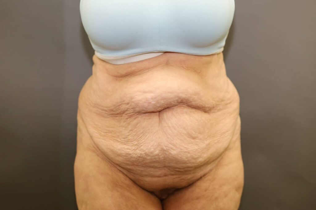 Before Image: Tummy Tuck - front