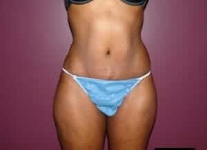 After Image: Tummy Tuck - front